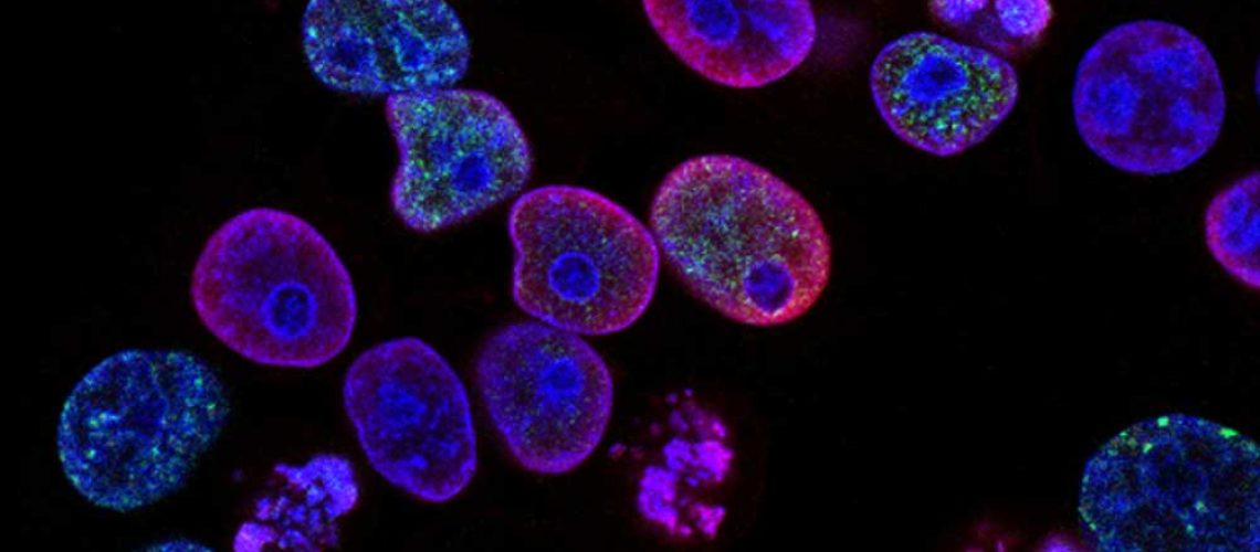 uro-cellules-cancereuses